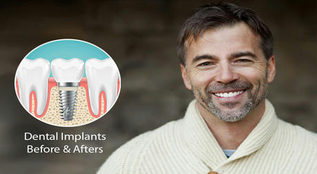 Dental Implants: Your Best Choice? Let the Data Tell You!
